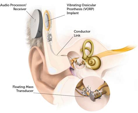 Middle ear implants - Clarity Hearing Solutions