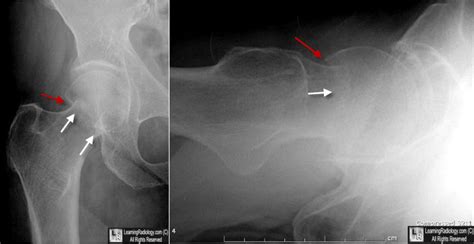 Learning Radiology - Fractures of the Proximal Femur