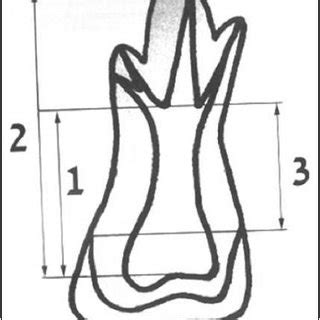 (PDF) Taurodontism: A dental rarity