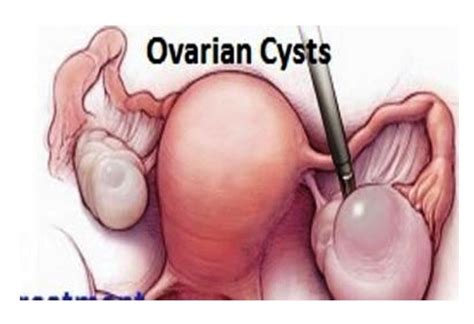 » Ovarian Cyst Pain