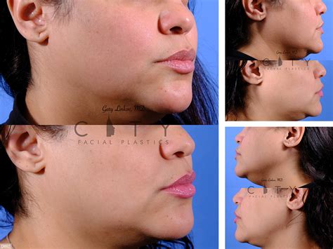 NYC Ear Lobe Repair Before and After Pictures | New York | UES