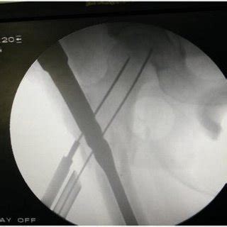 (PDF) Proximal femoral nail- outcome and complications: a prospective study of 125 cases of ...