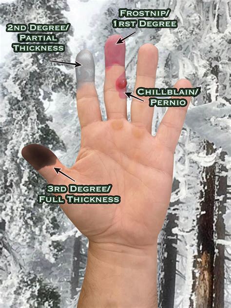 Recognizing Frostbite : r/Survival