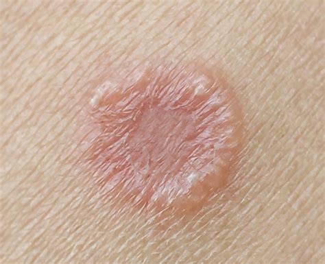 Tinea Manuum: Symptoms, Causes & Treatment