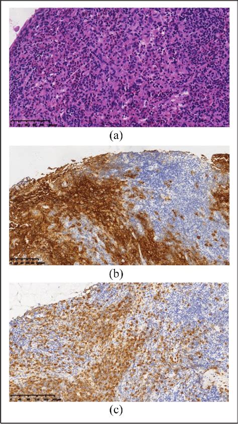 Figure 1 from Langerhans cell histiocytosis developing acute lymphoblastic leukemia | Semantic ...