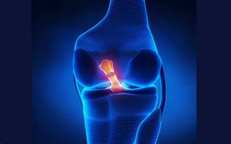 Symptoms of a Torn ACL, What to do at Home