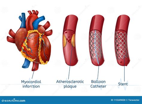 Rca Stent