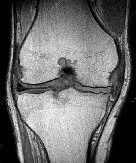 Knee Arthritis, MRI - Stock Image - C027/1219 - Science Photo Library