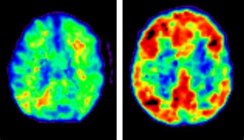 All you need to know about brain scans and dementia - Alzheimer's Research UK