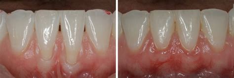 Receding Gums – Lane Ends Dental Practice – Preston