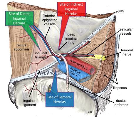 Direct Hernia vs Indirect Hernia – Moosmosis