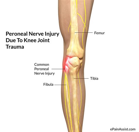 Peroneal Nerve; Fibular Nerve