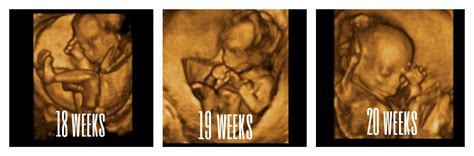 3D 4D- Ultrasound Pictures- Youngstown, Boardman Ohio