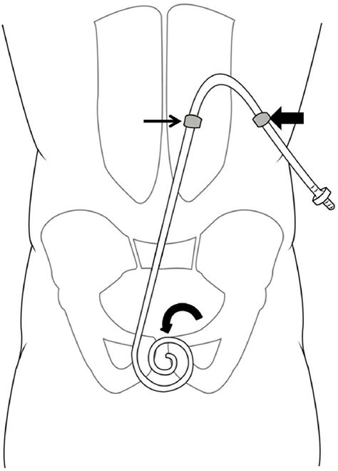 Figure 1 from Best Practices Consensus Protocol for Peritoneal Dialysis Catheter Placement by ...