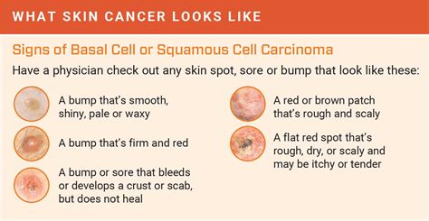 How to Detect Skin Cancer | Roswell Park Comprehensive Cancer Center - Buffalo, NY