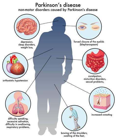 parkinson’s-disease-symptoms | Kahpi