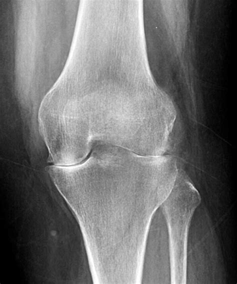 Rheumatoid Arthritis Knee Mri