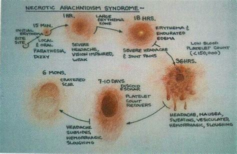 Spider Bite Visuals and Symptoms