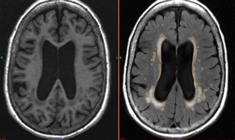 white matter disease mri Mri lesions diffuse axial - Diseases Club center