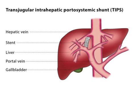 Transjugular intrahepatic portosystemic shunt (TIPS) – CIRSE | Tips procedure, Interventional ...