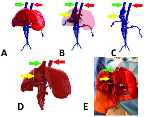 Preoperative stages of the shunt visualization of patient no 1: (A)... | Download Scientific Diagram