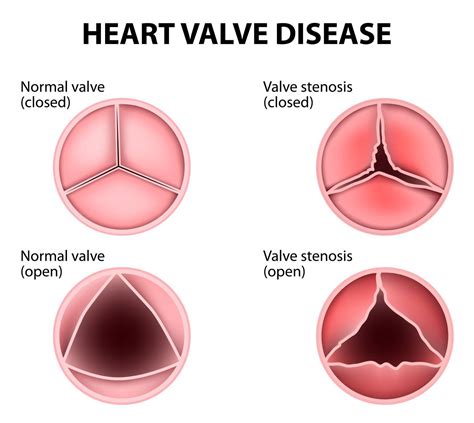 Heart Murmur Guide: Causes, Symptoms and Treatment Options