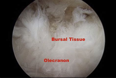 Arthroscopic view of the olecranon bursa from a posterior central... | Download Scientific Diagram