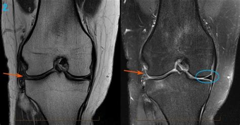 MRI Scan Knee Melbourne | Melbourne Radiology Clinic