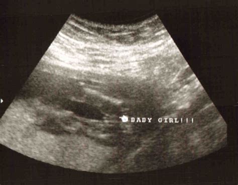 Gender Ultrasound Pictures!!!! - BabyCenter