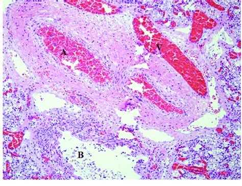 Pulmonary Artery Histology