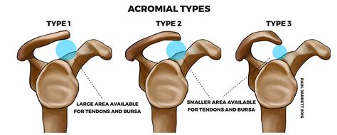 Types Of Acromion Shapes