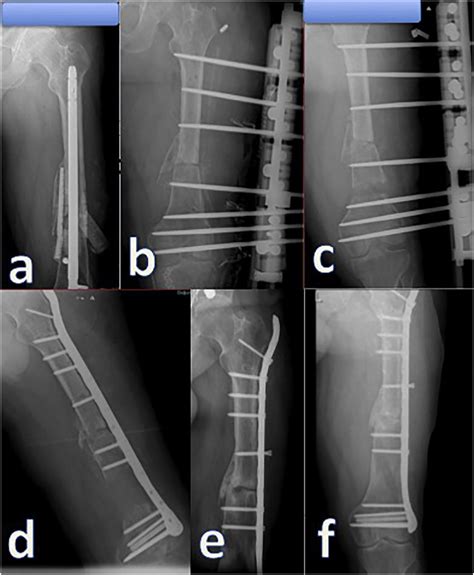 a, femoral defective nonunion after intramedullary nailing. b,removal... | Download Scientific ...