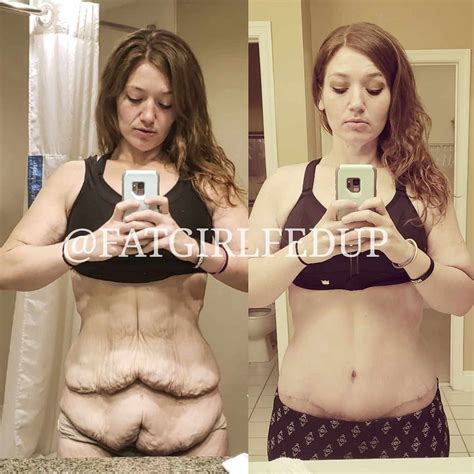 Lexi Reed Reflects on Her Skin Removal Surgery Progress