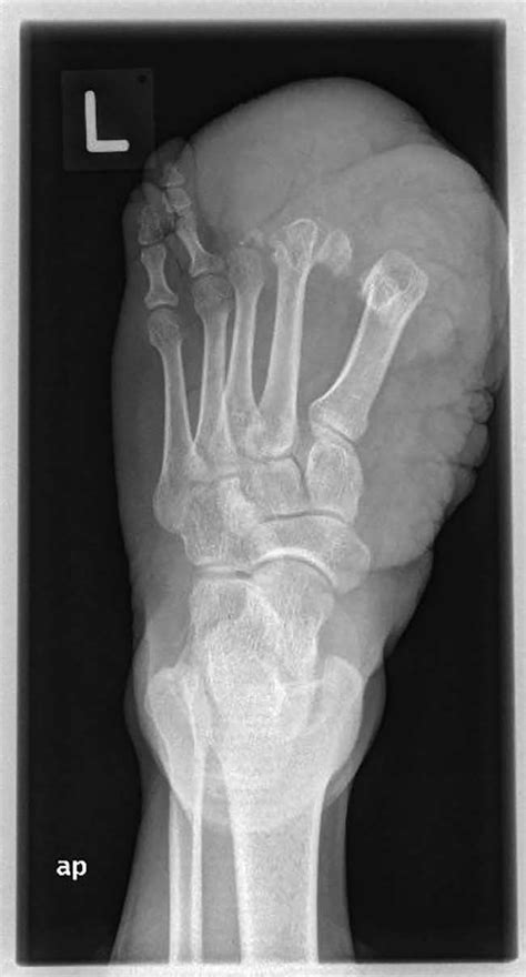 X-ray image of the patient's left foot (anteroposterior view), showing... | Download Scientific ...