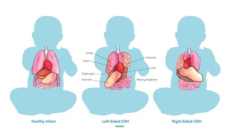 Congenital Diaphragmatic Hernia