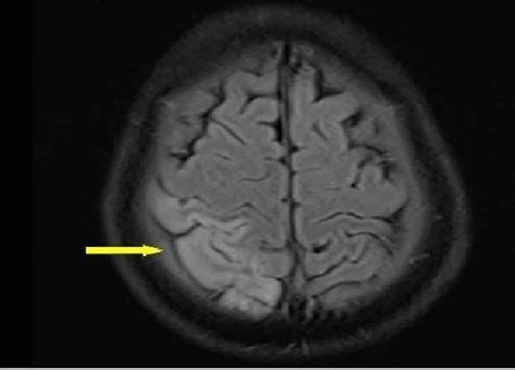 Axial FLAIR MRI was observed singal increases the right parietal lobe... | Download Scientific ...