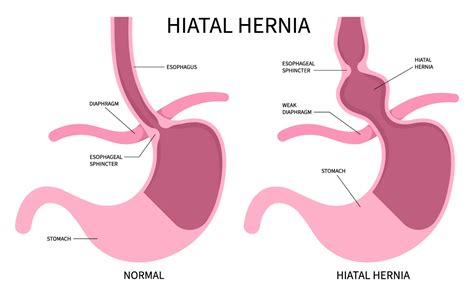 Hiatal Hernia Symptoms & Treatment | Aurora Health Care