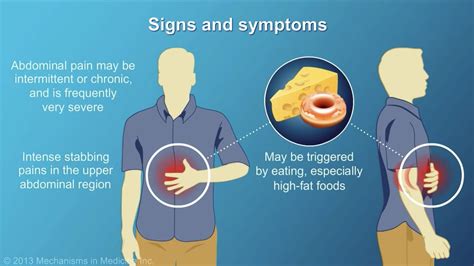 Acute Pancreatitis Signs And Symptoms