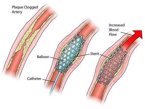 Procedures & Devices - Heart Research Australia