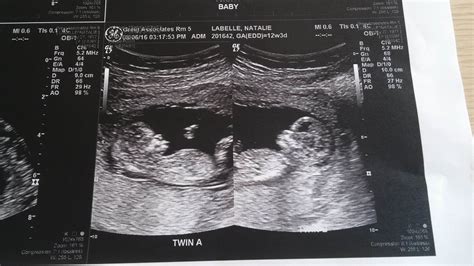 12 Weeks Pregnant Ultrasound Twins