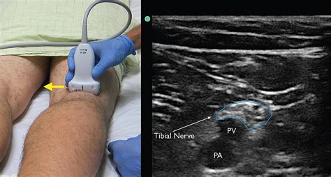 Figure 4. The tibial nerve sits just above the popliteal artery (PA) and popliteal vein (PV ...