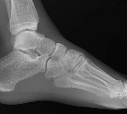 5th Metatarsal Base Fracture - Foot & Ankle - Orthobullets