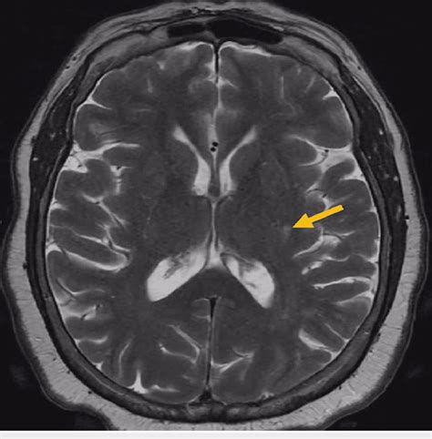 MRI of the brain showing scattered T2 hyperintensities in the... | Download Scientific Diagram