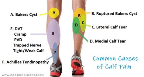 Calf Muscle Pain: Causes & Treatment - Knee Pain Explained (2022)