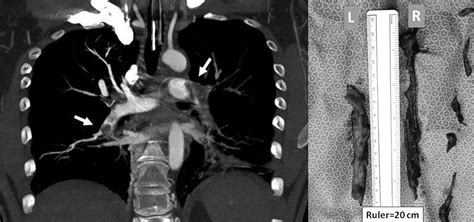 Pulmonary computed tomography angiography showing complete obstruction... | Download Scientific ...