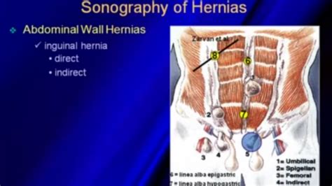 Can Hernia Mesh Be Seen On Ultrasound