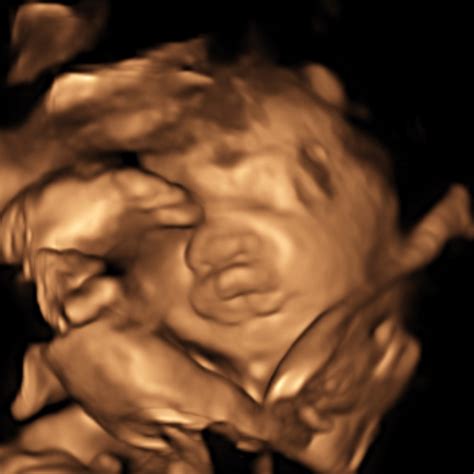 30 Weeks 3D - Firstview Ultrasound