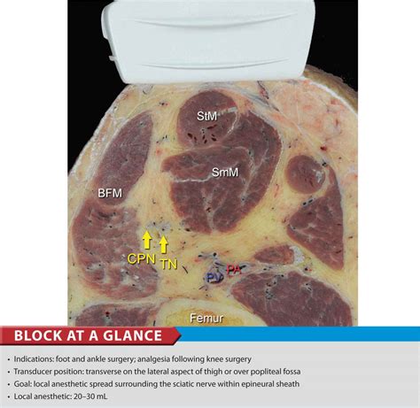 Ultrasound-Guided Popliteal Sciatic Block | Anesthesia Key