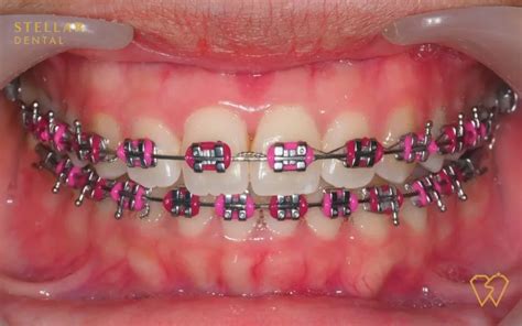 Braces Colors: Top Picks For 2023 - Stellar Dental