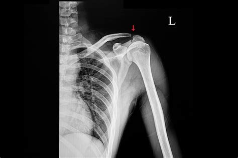 Acromion Fracture